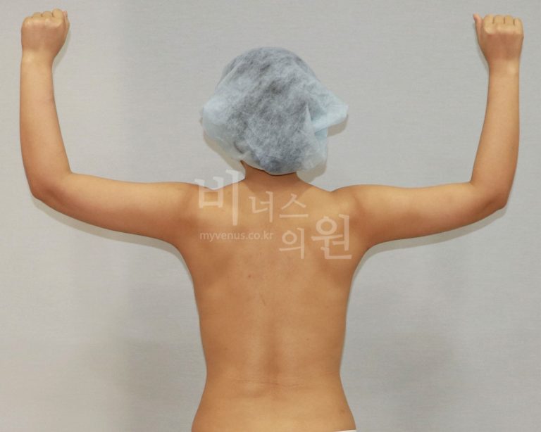팔뚝 지방흡입 수술 다음날부터 직장 복귀까지 — 비너스의원 1주일 회복 경험담