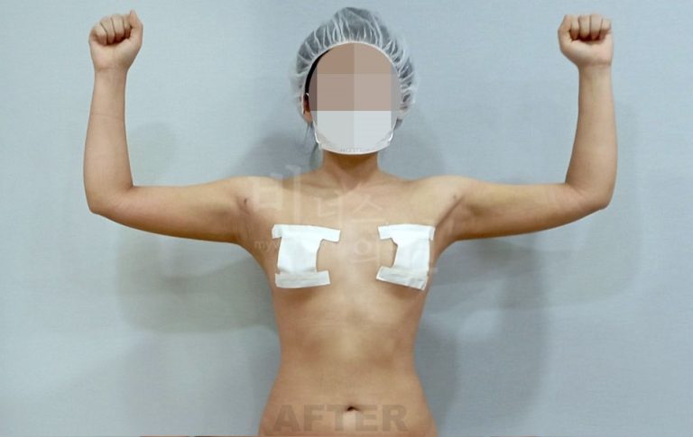 팔뚝 맥시머 지방흡입, 여름 전 결심했습니다 — 수술부터 소매 없는 원피스까지 3개월 회복 일지