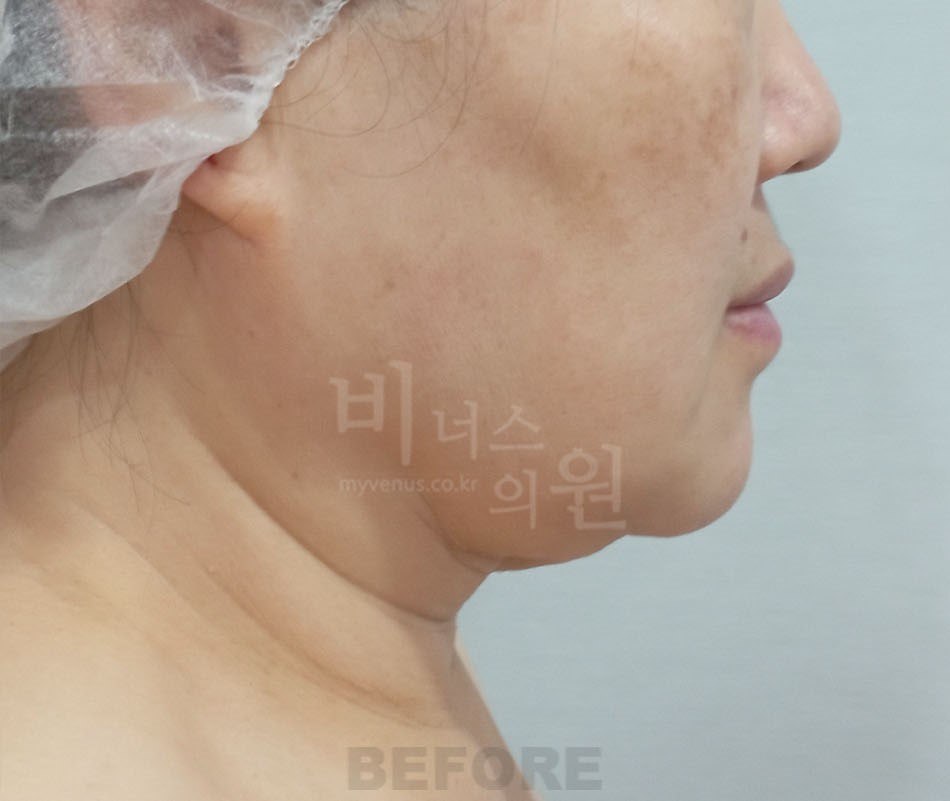 턱지방흡입 전 측면2 비너스의원