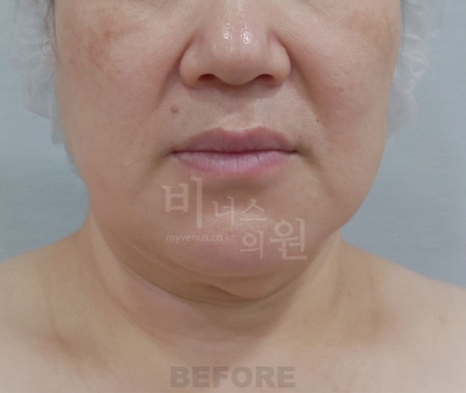 턱지방흡입 전 정면 비너스의원