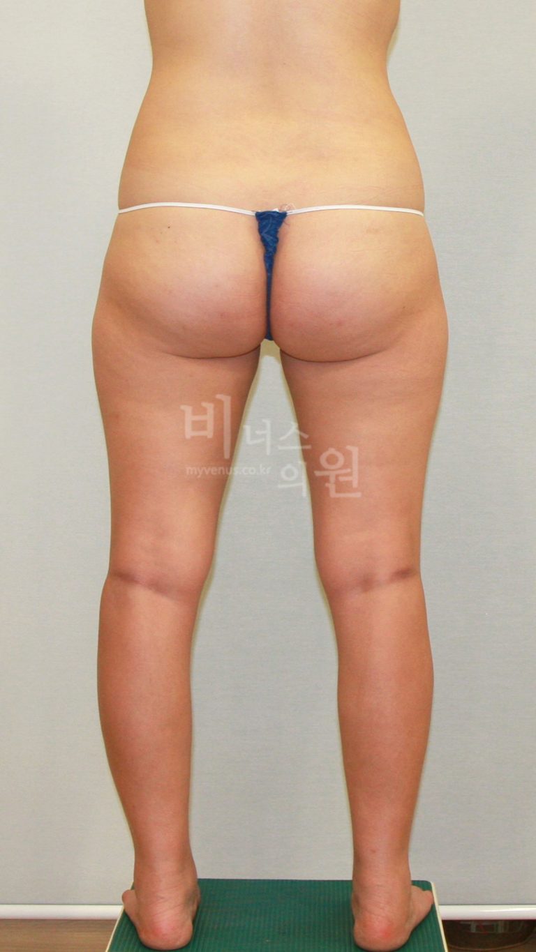 허벅지 지방흡입 후기 — 수술 당일부터 한 달까지 회복 과정을 솔직하게 정리했어요