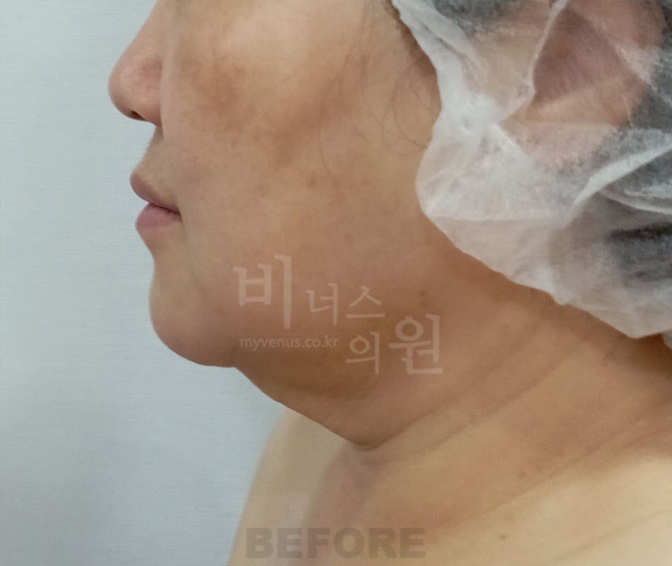 턱지방흡입 전 측면 비너스의원