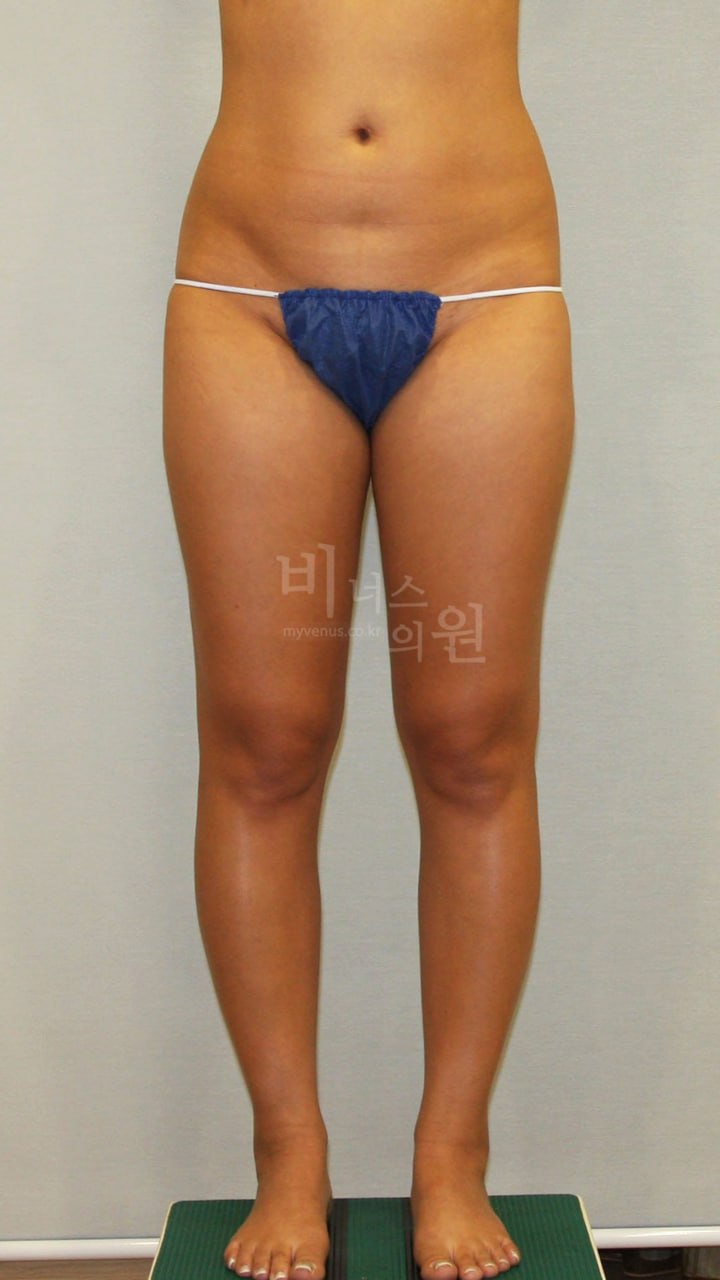 엉덩이 볼륨업 지방흡입 수술 전 정면