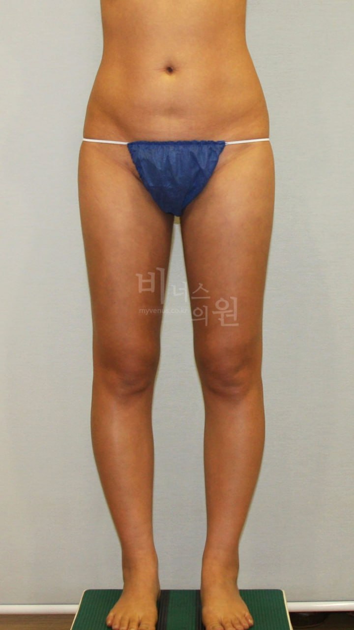 엉덩이 지방흡입 전에 이 고민 정말 오래 했어요 — 수술 결심부터 첫 1주일까지