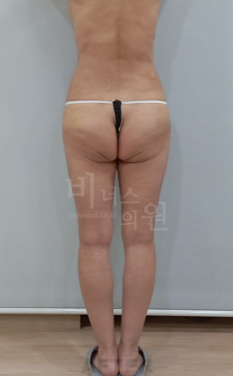 엉덩이 지방흡입 후 후면