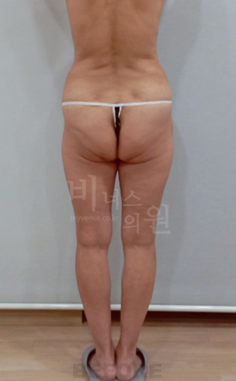 엉덩이 지방흡입, 수술 전 고민부터 체형 변화까지 – 하체 비율이 달라진 솔직 후기