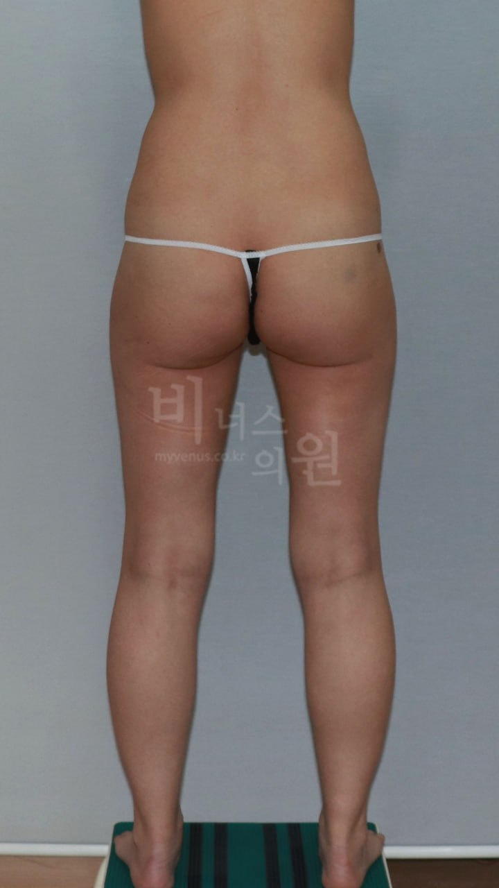 엉덩이 지방흡입 전 (사례2)