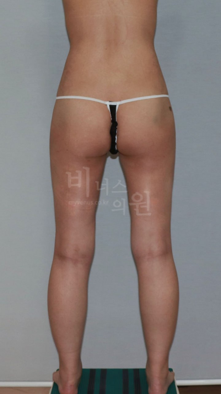 엉덩이 지방흡입 후 (사례2)