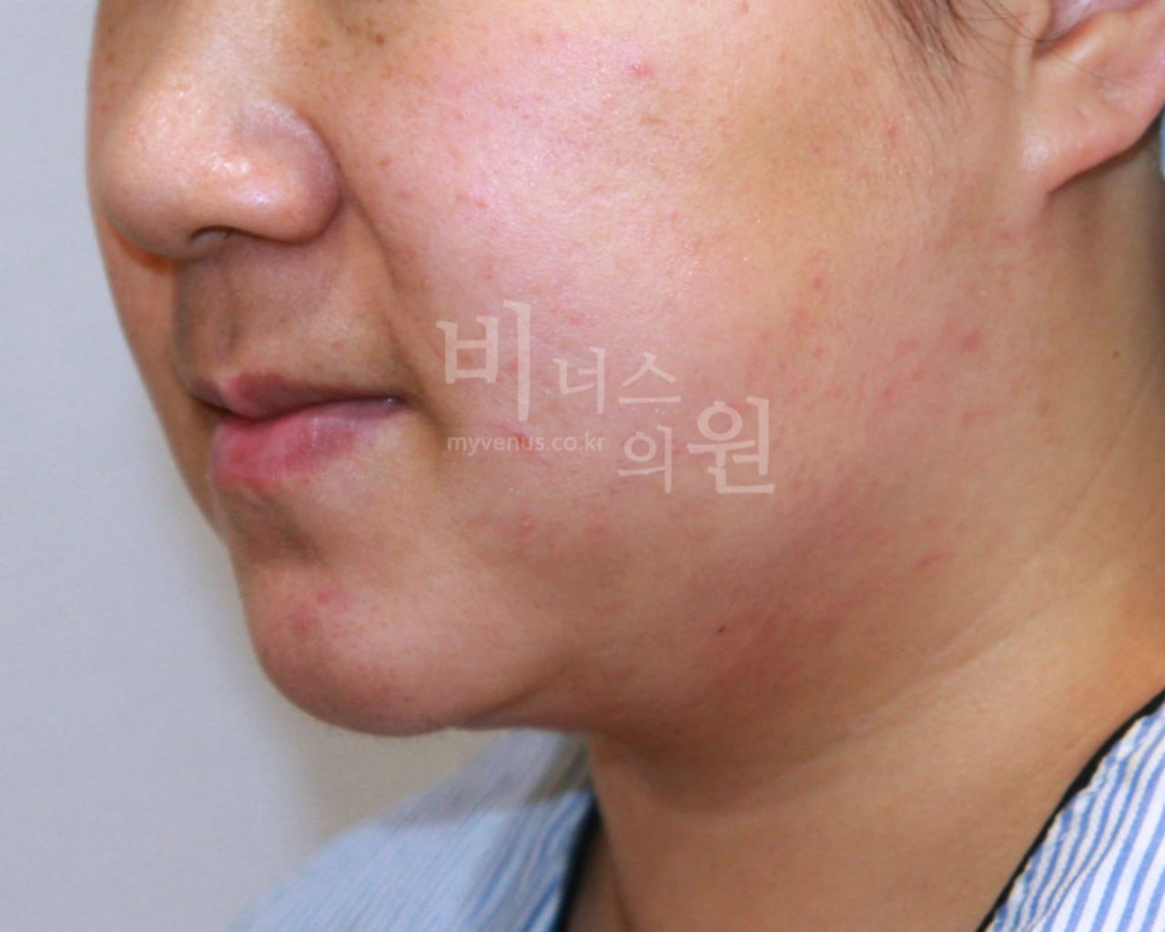 턱지방흡입 후