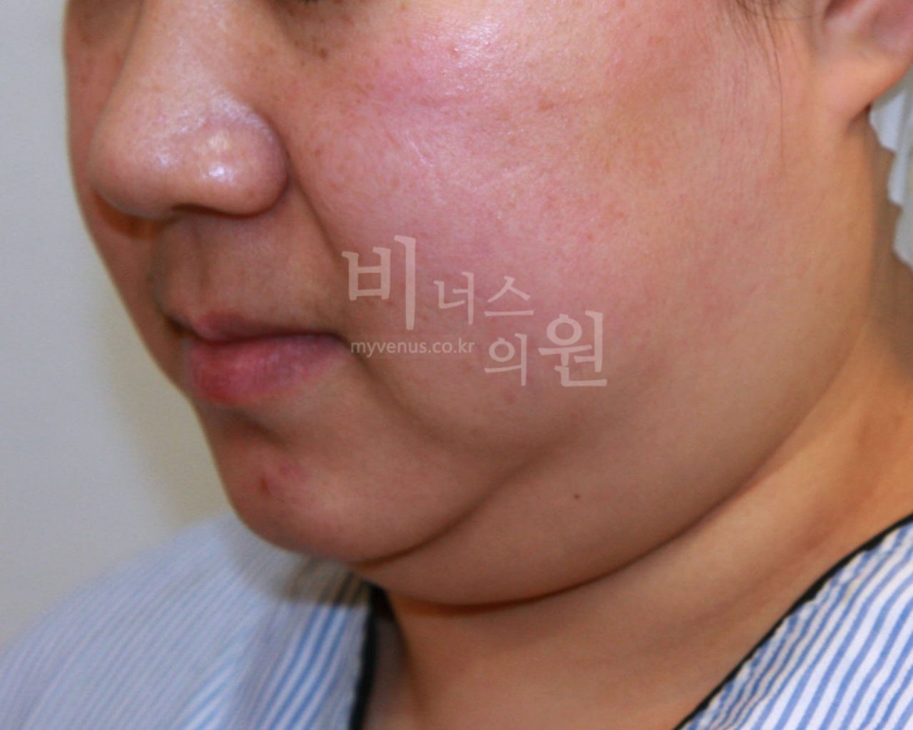 턱지방흡입 전