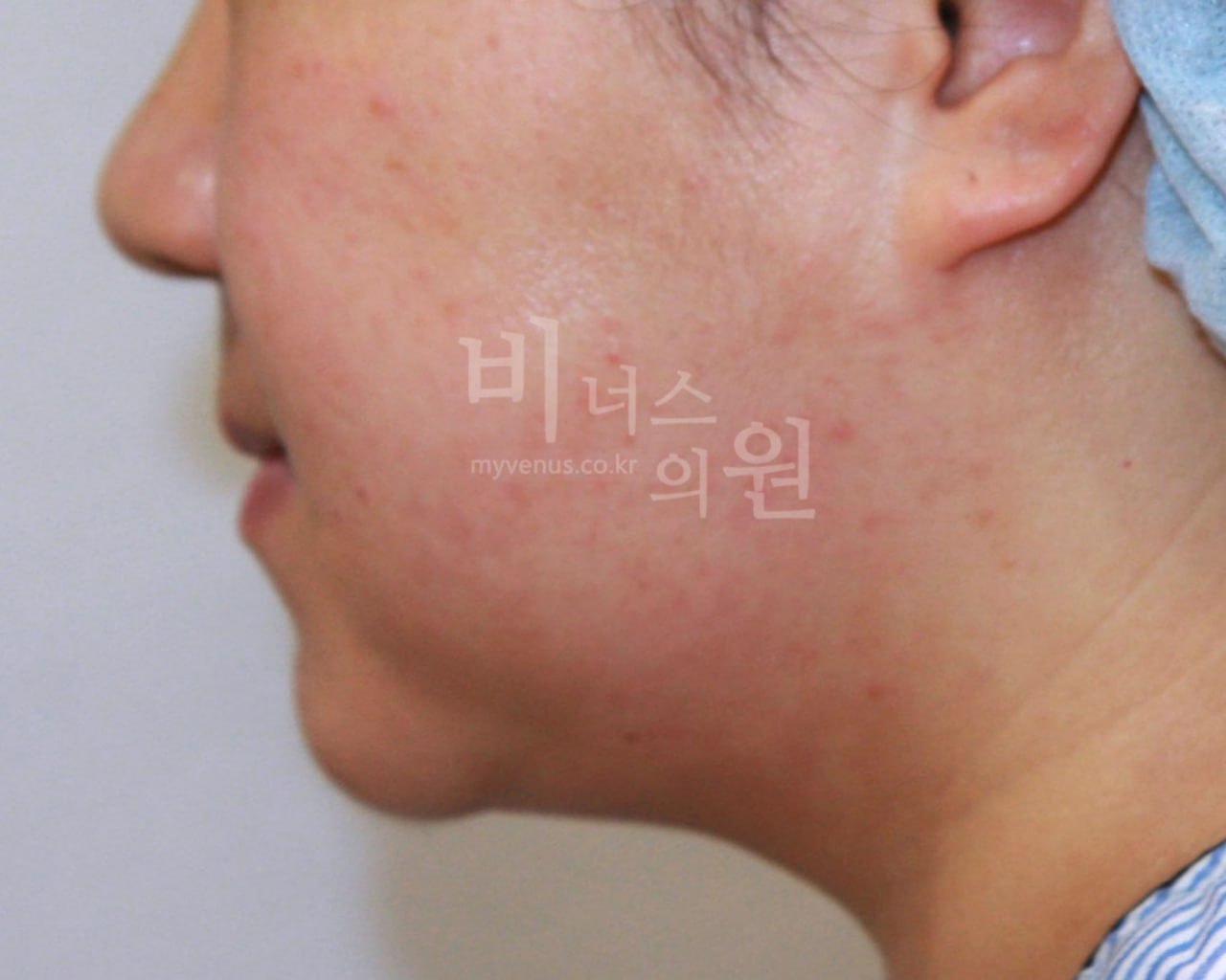 턱지방흡입 후