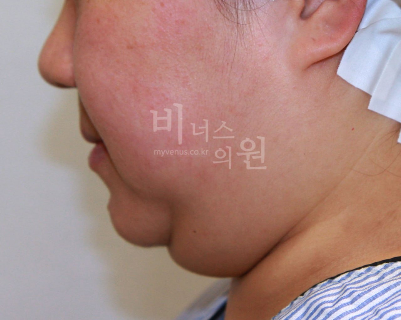 턱지방흡입 전