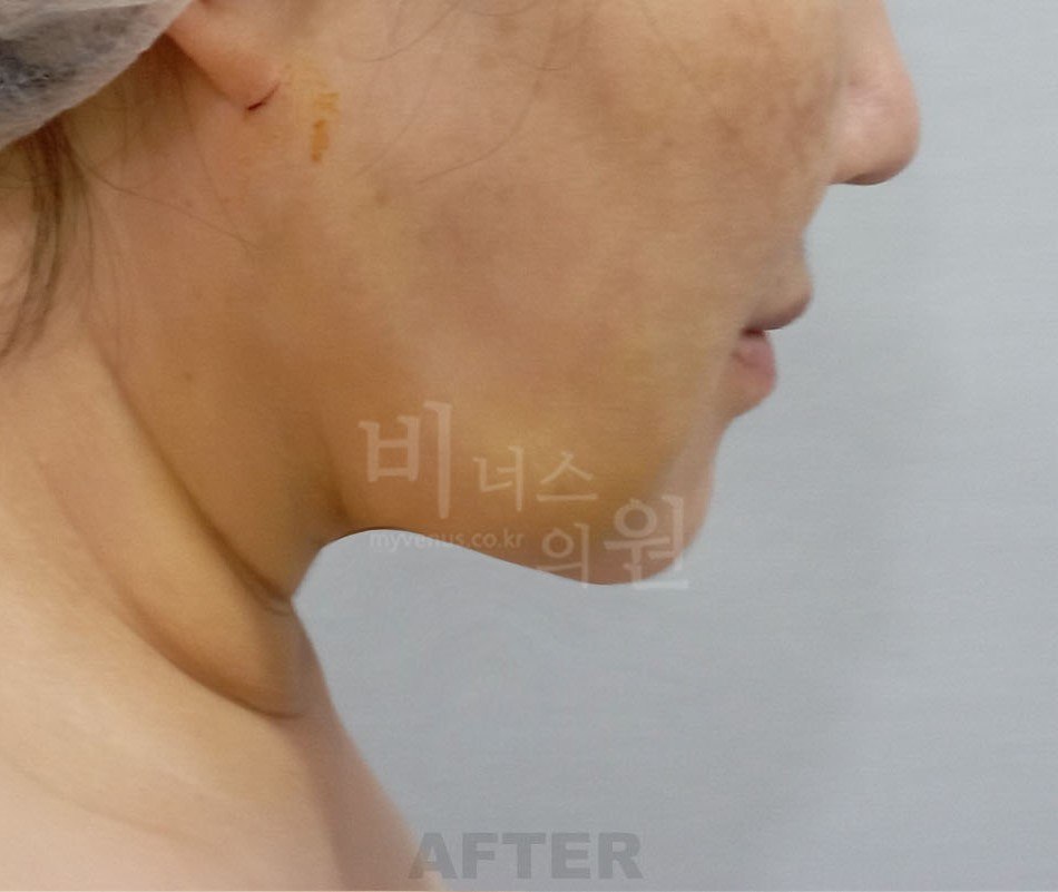 턱지방흡입 후 측면2 비너스의원