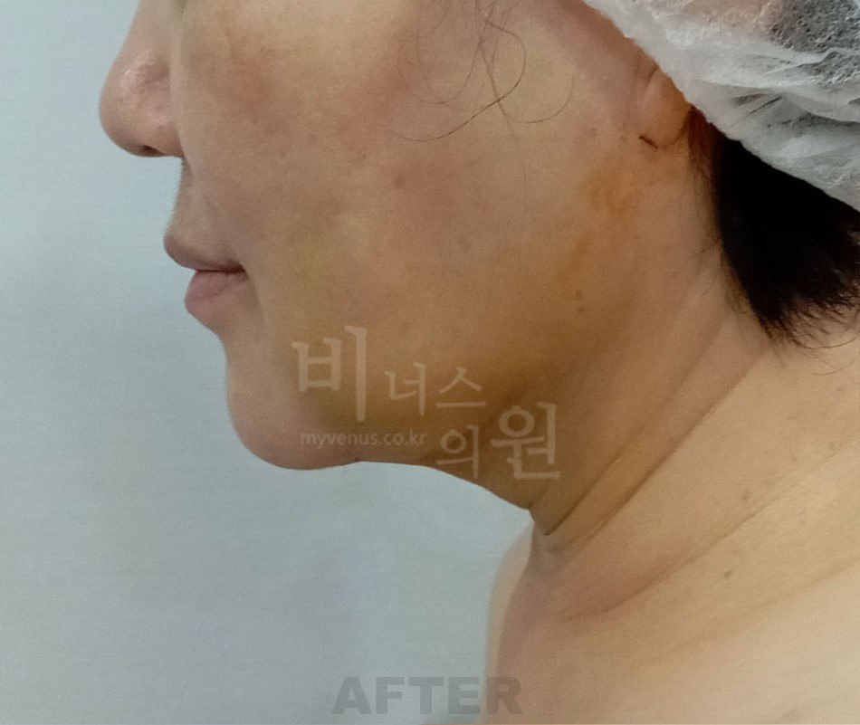턱지방흡입 후 측면 비너스의원