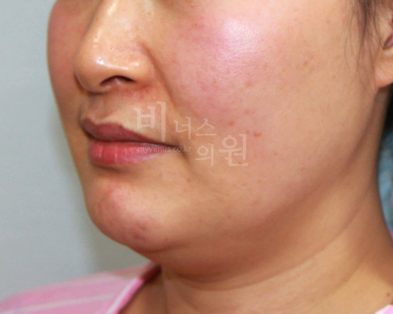 턱지방흡입 전 사진 케이스2 — 비너스의원