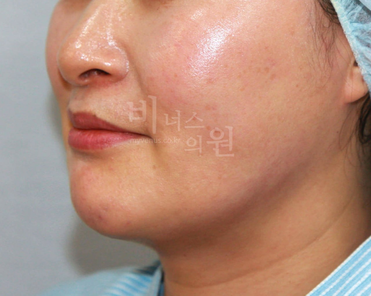 턱지방흡입 후 사진 케이스2 — 비너스의원