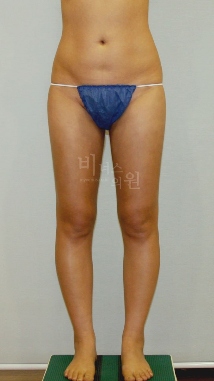 허벅지 맥시머 지방흡입 수술 후 1주일 정면