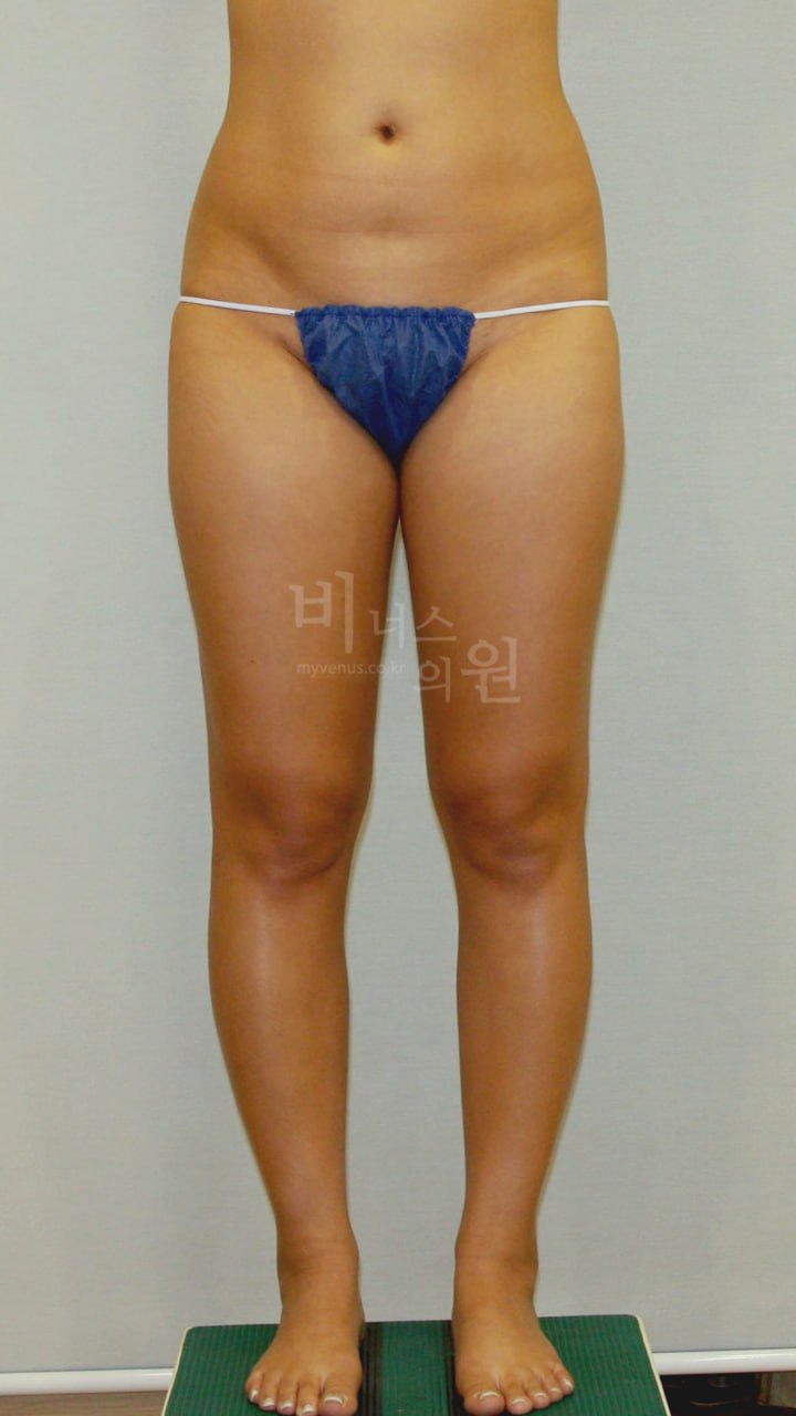 허벅지 맥시머 지방흡입 수술 전 정면