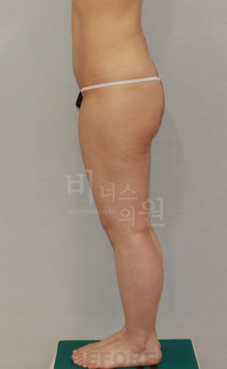 수술 전