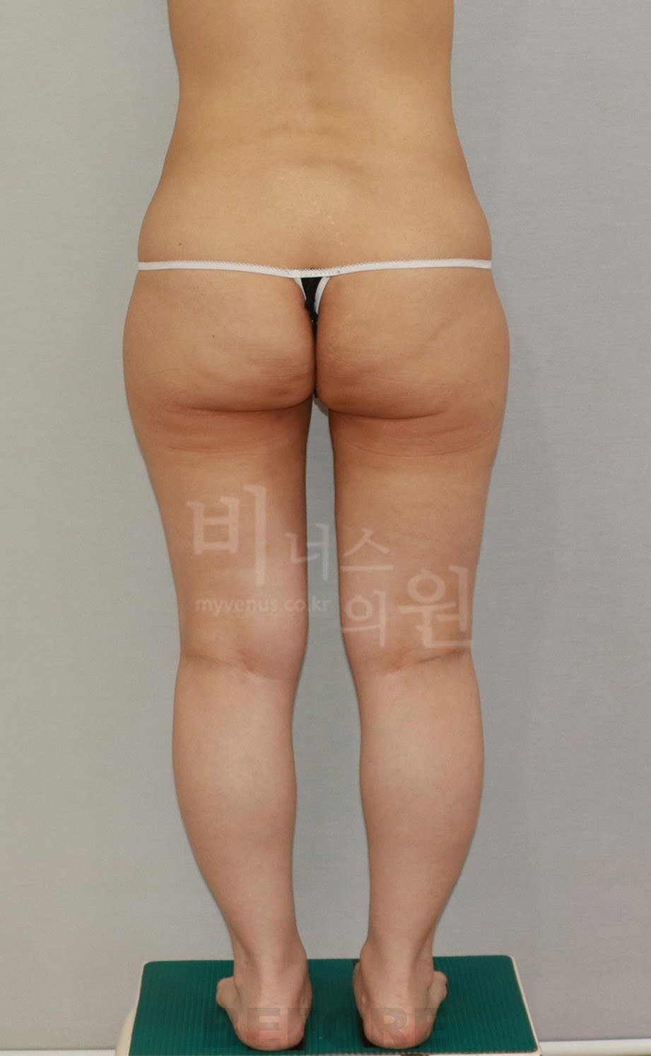 수술 전