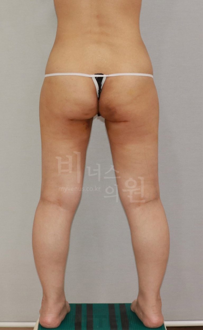 엉덩이 지방흡입 힙업 수술 후기 – 고민부터 3개월 변화까지