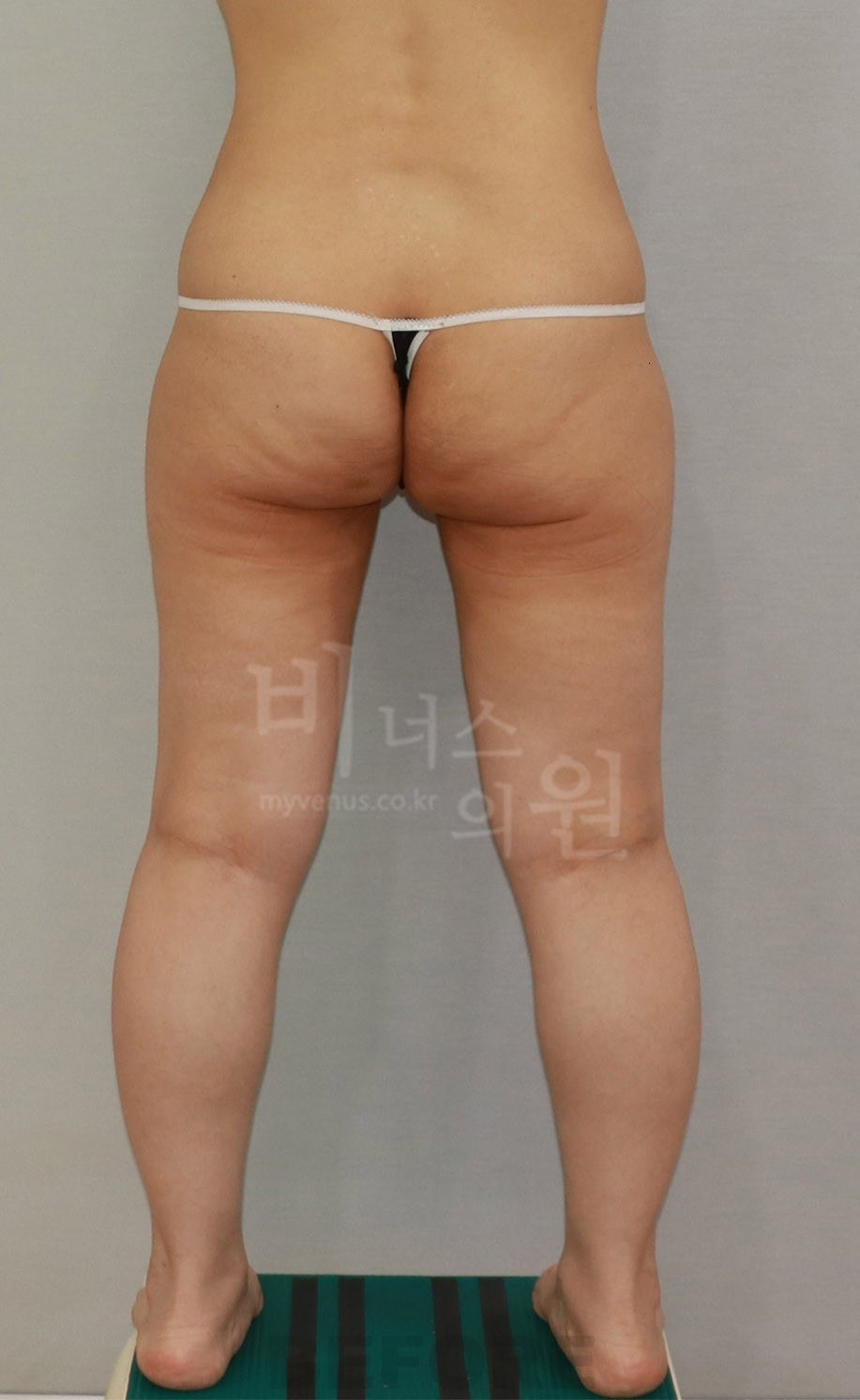 수술 전