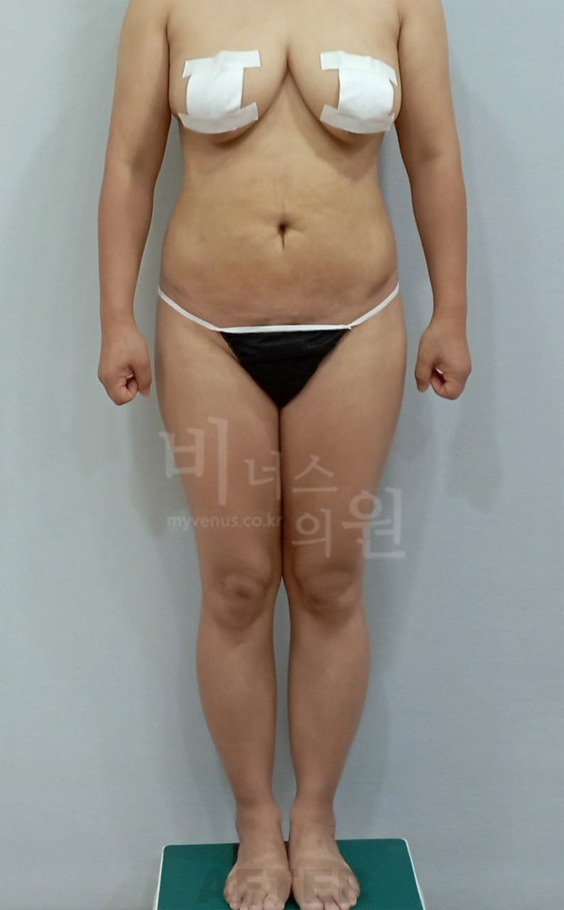 정면 수술 후