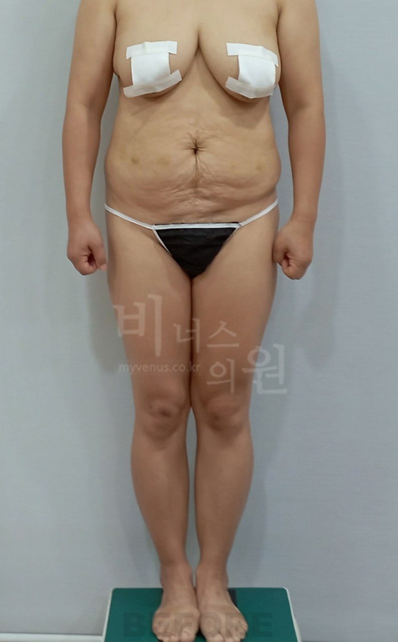 정면 수술 전
