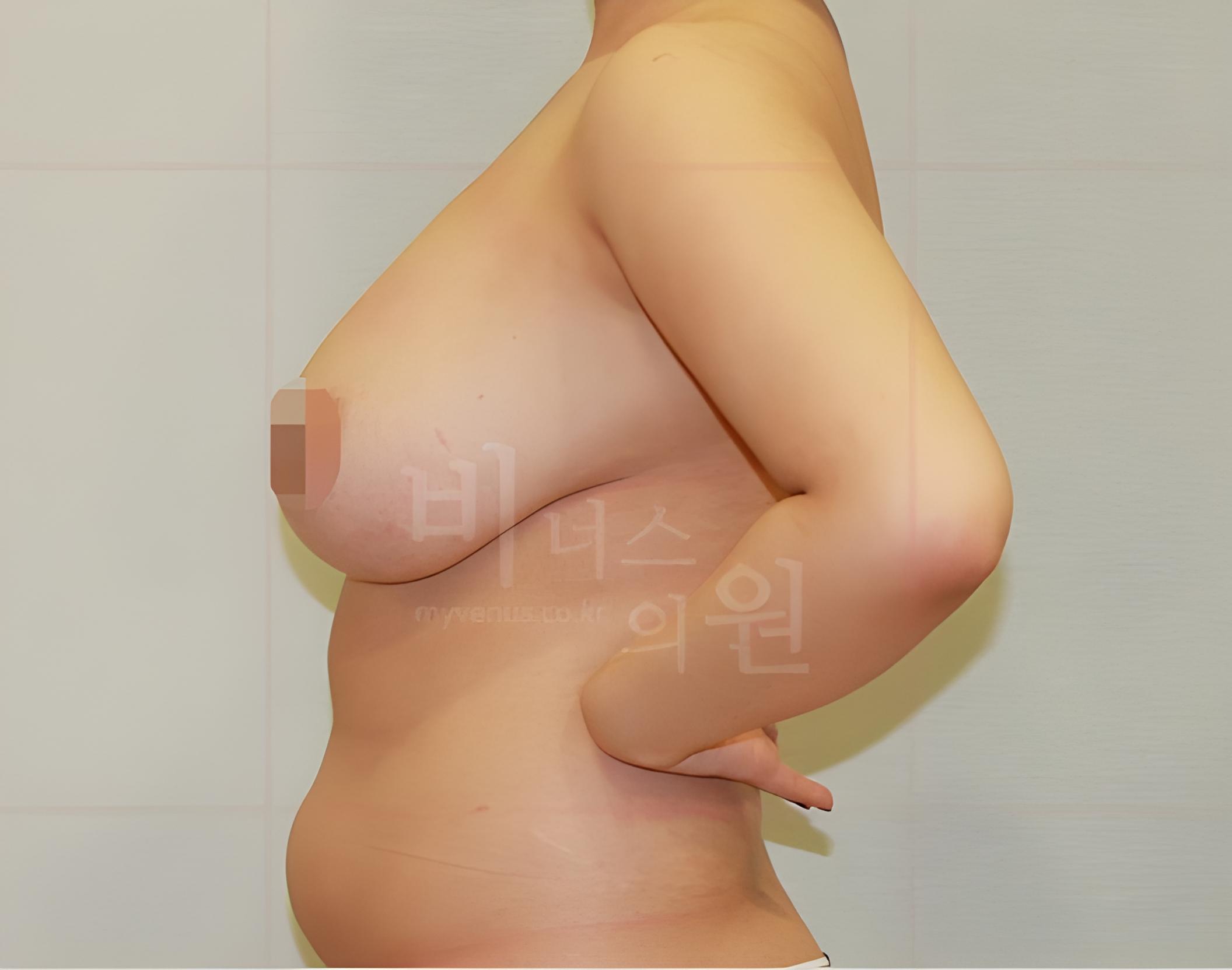 유방축소 지방흡입 수술 전 정면