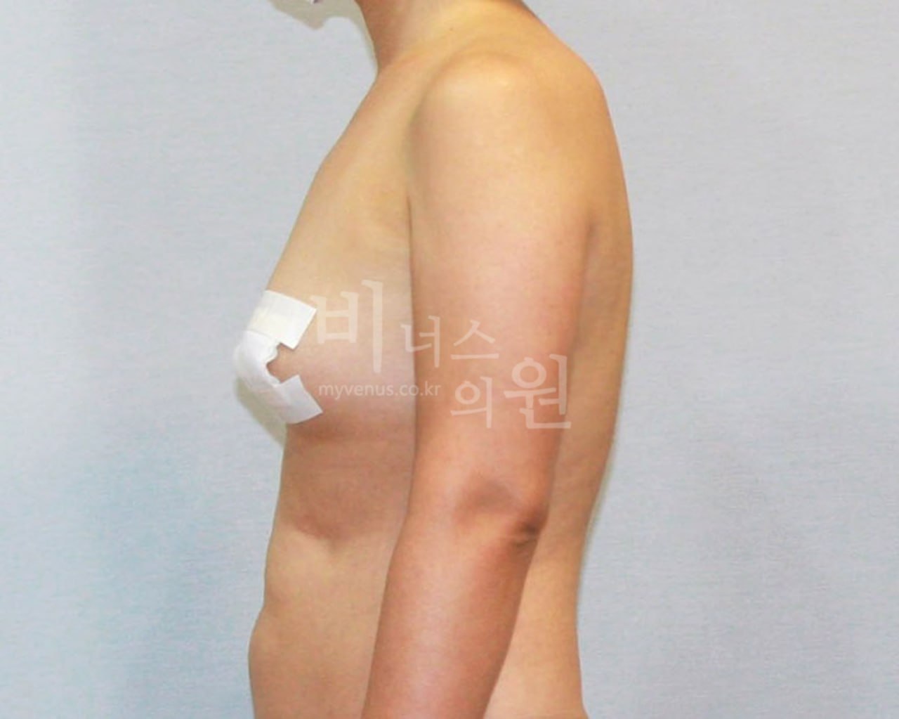 팔뚝 지방흡입 수술 후 측면 — 비너스의원