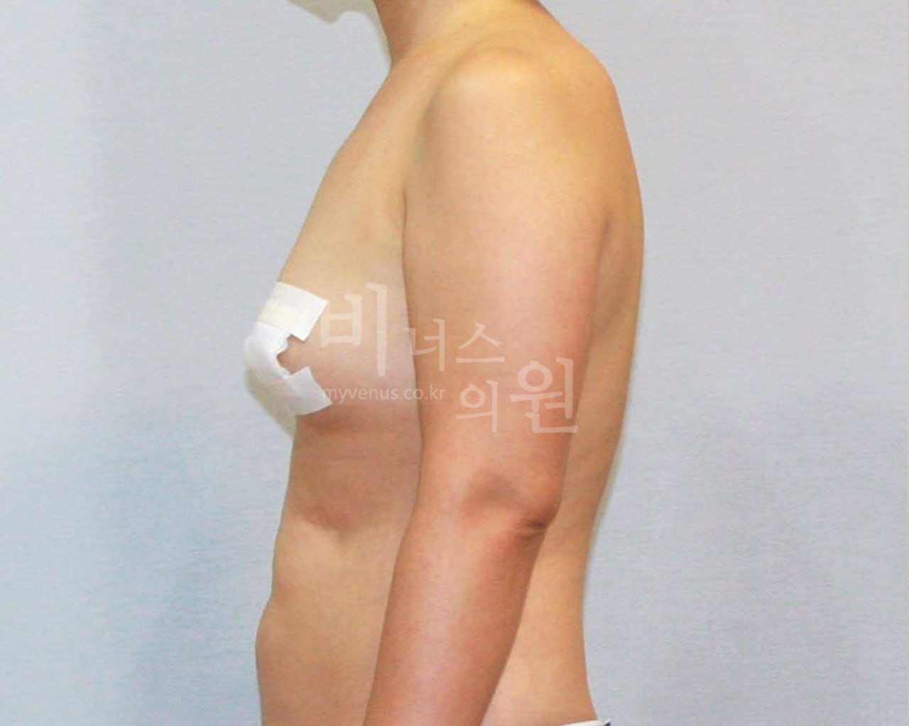 팔뚝 지방흡입 수술 전 측면 — 비너스의원