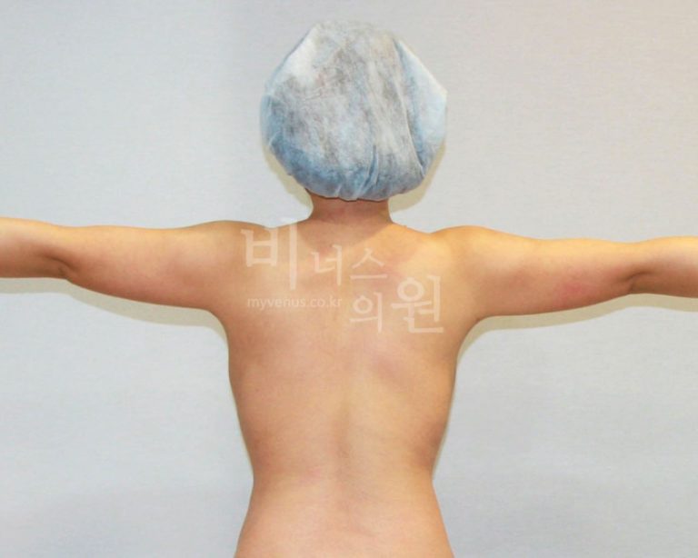 팔뚝지방흡입 경험담 — 수술 전 걱정했던 것들과 실제 회복 과정