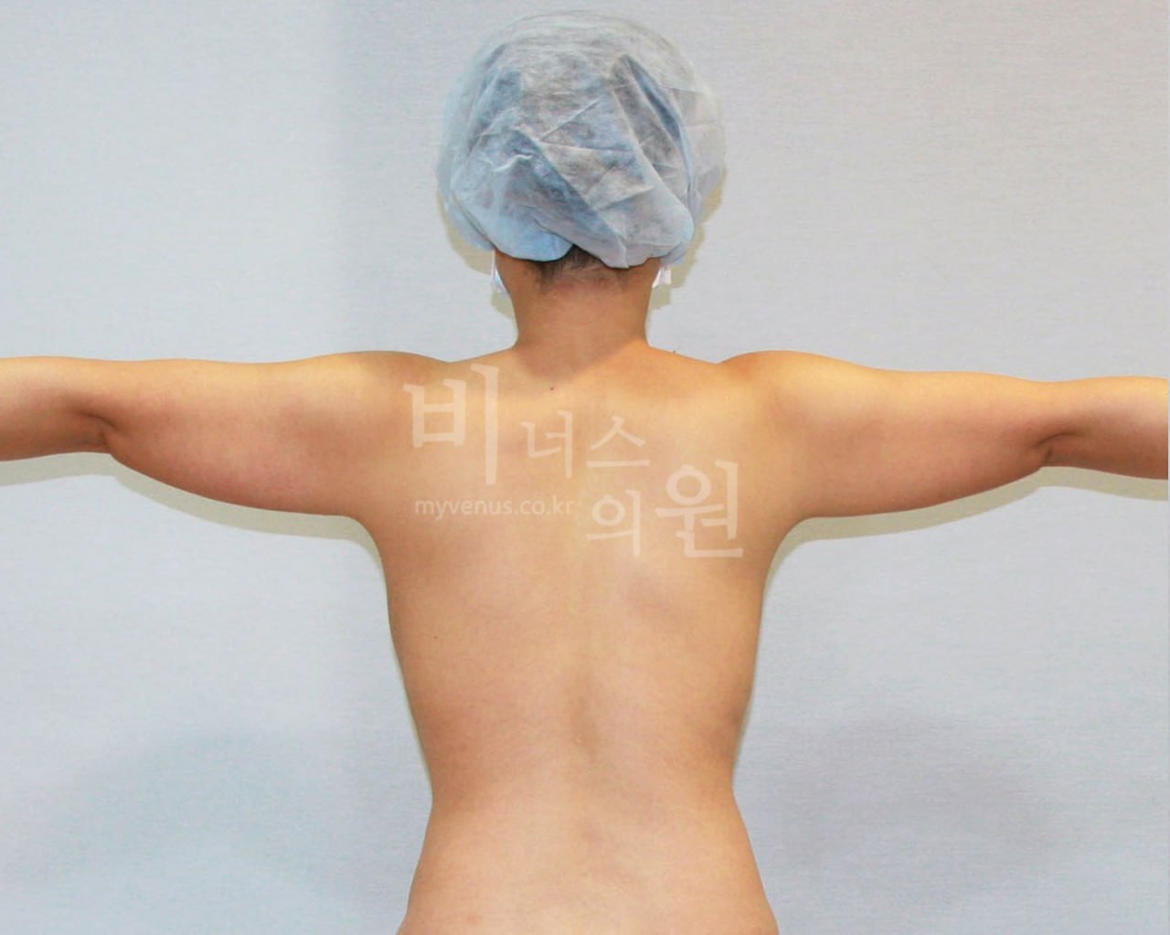 팔뚝 지방흡입 수술 전 T자 후면 — 비너스의원