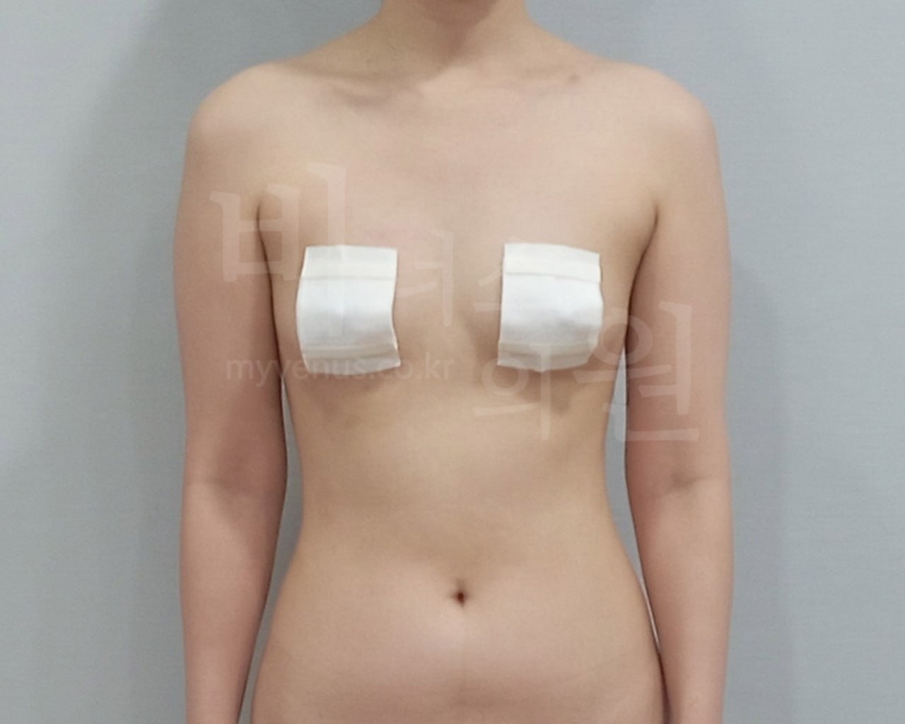 팔뚝 지방흡입 수술 전 정면
