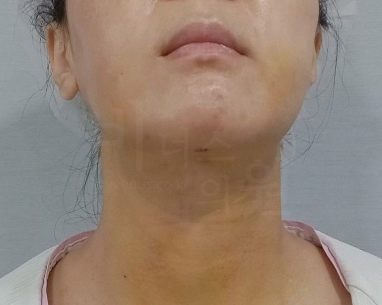 턱지방흡입 회복 일기 — 수술 다음날부터 한 달, 이중턱 없애고 달라진 것들