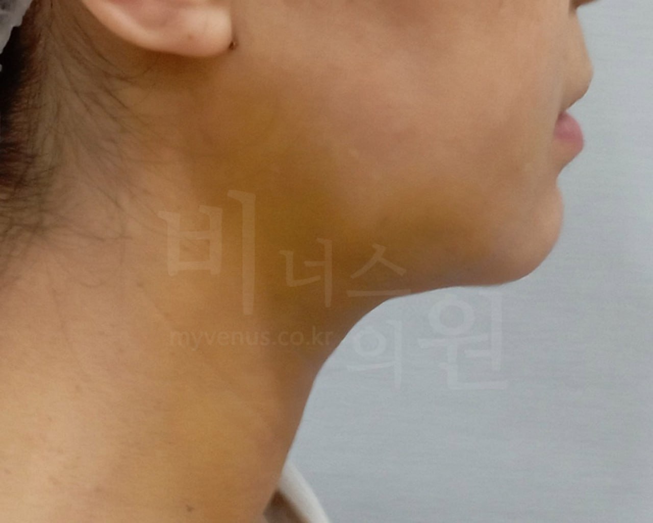턱지방흡입 후 45도 비너스의원