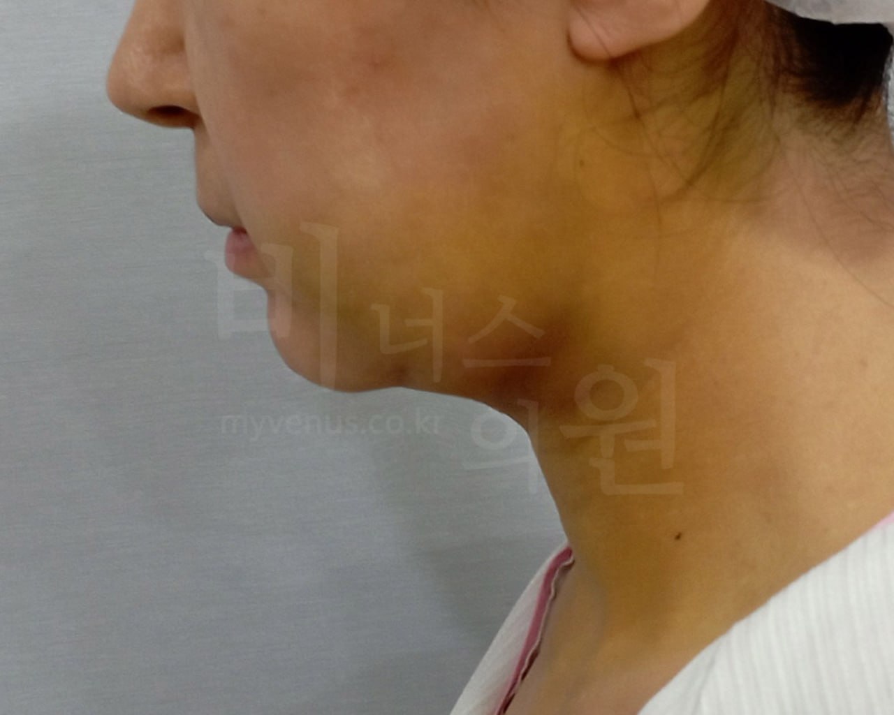 턱지방흡입 후 측면 비너스의원