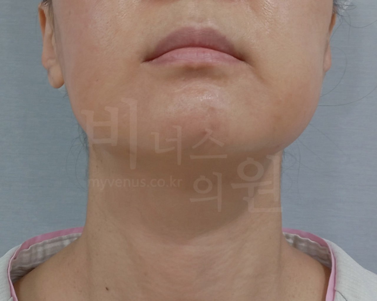 턱지방흡입 전 정면 비너스의원