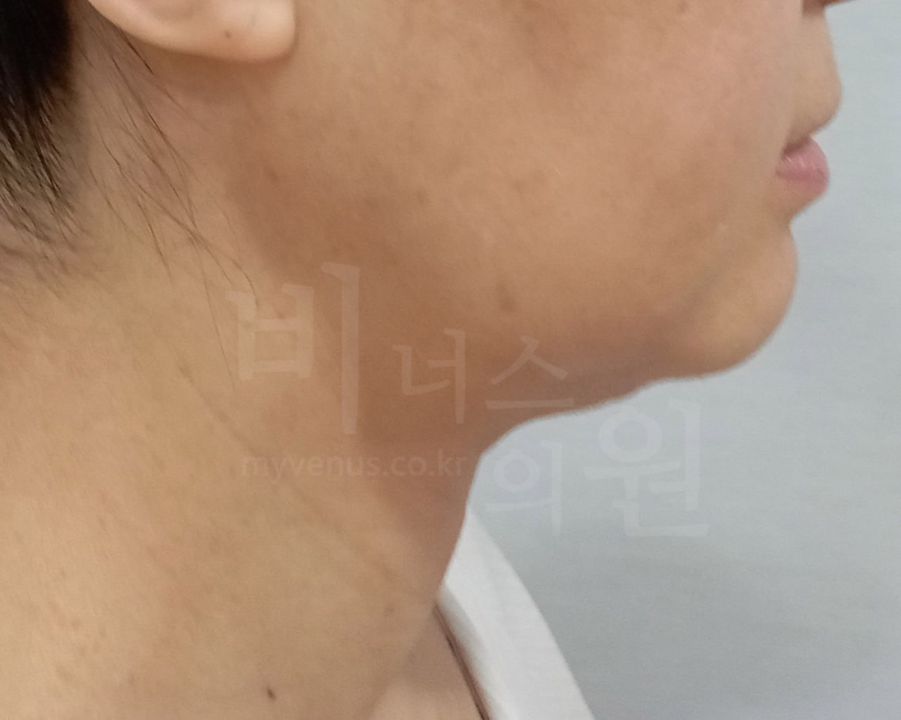 턱지방흡입 전 45도 비너스의원