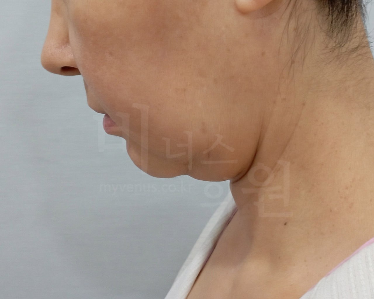 턱지방흡입 전 측면 비너스의원