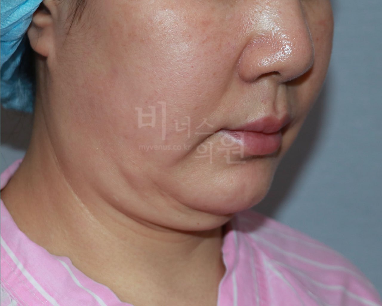 이중턱 지방흡입 수술 전 비너스의원