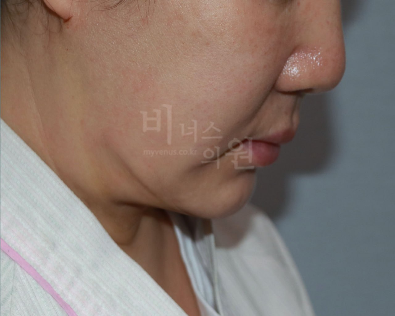 이중턱 지방흡입 수술 후 비너스의원