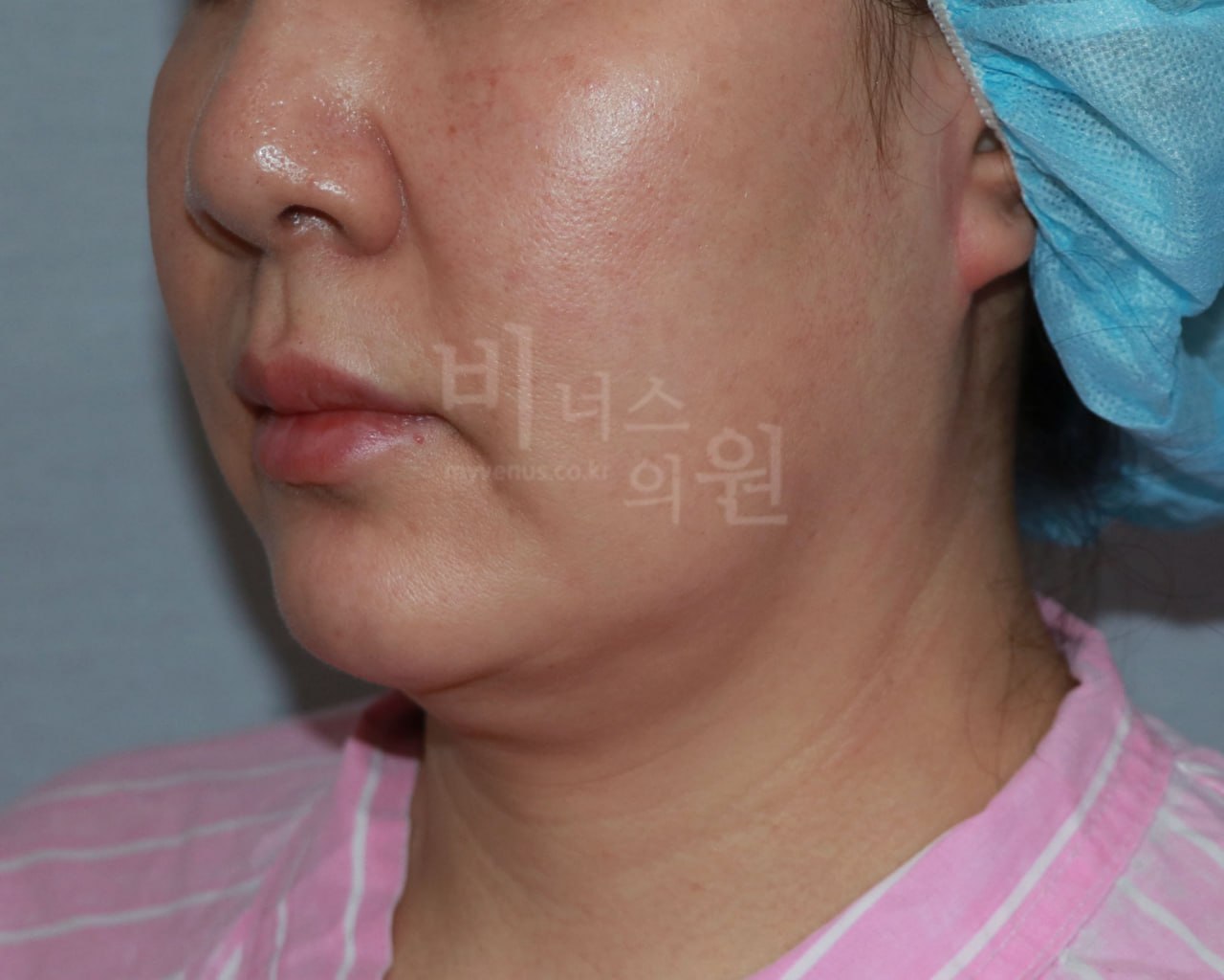 이중턱 지방흡입 수술 전 비너스의원