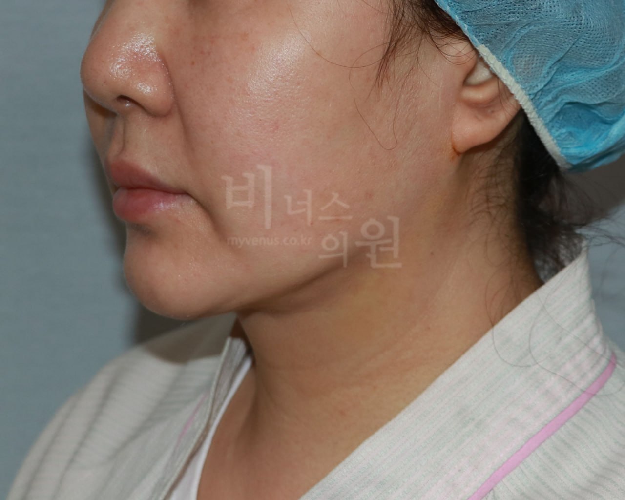 이중턱 지방흡입 수술 후 비너스의원