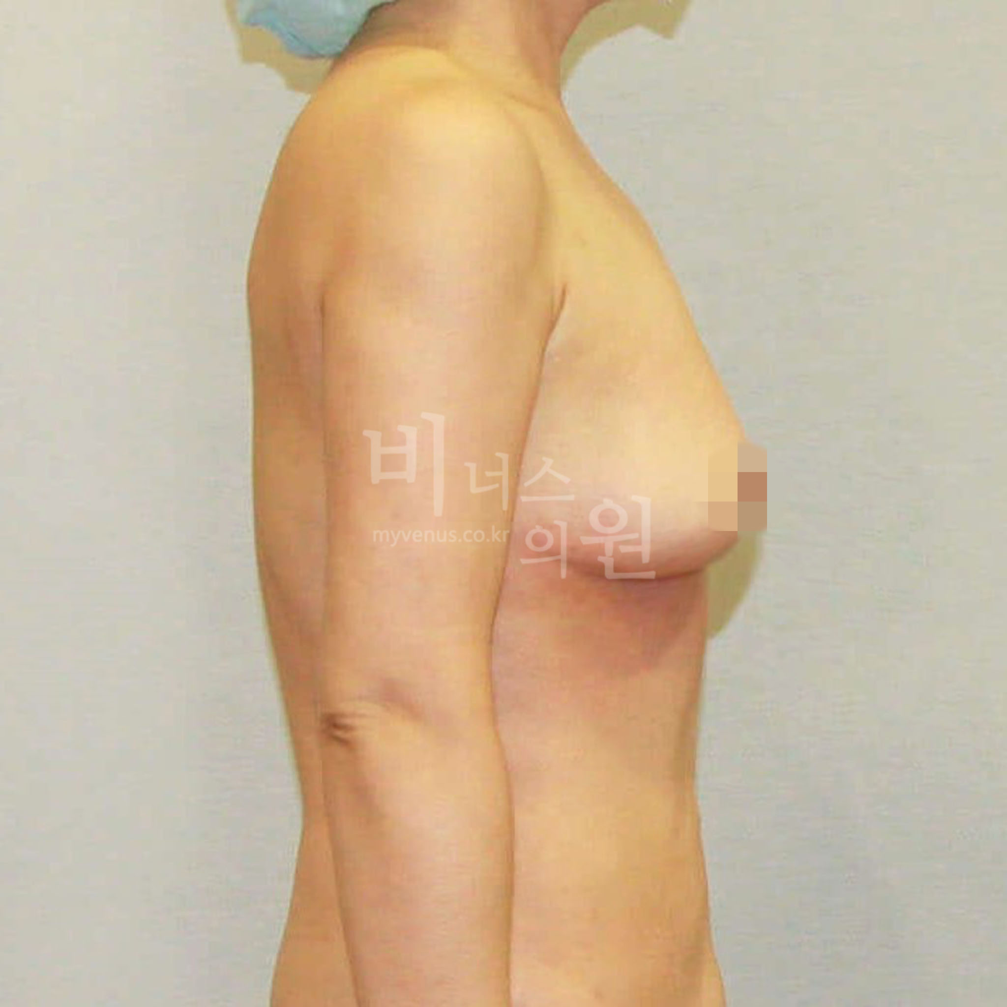 가슴축소 지방흡입 전후 — 측면 수술 후 비너스의원