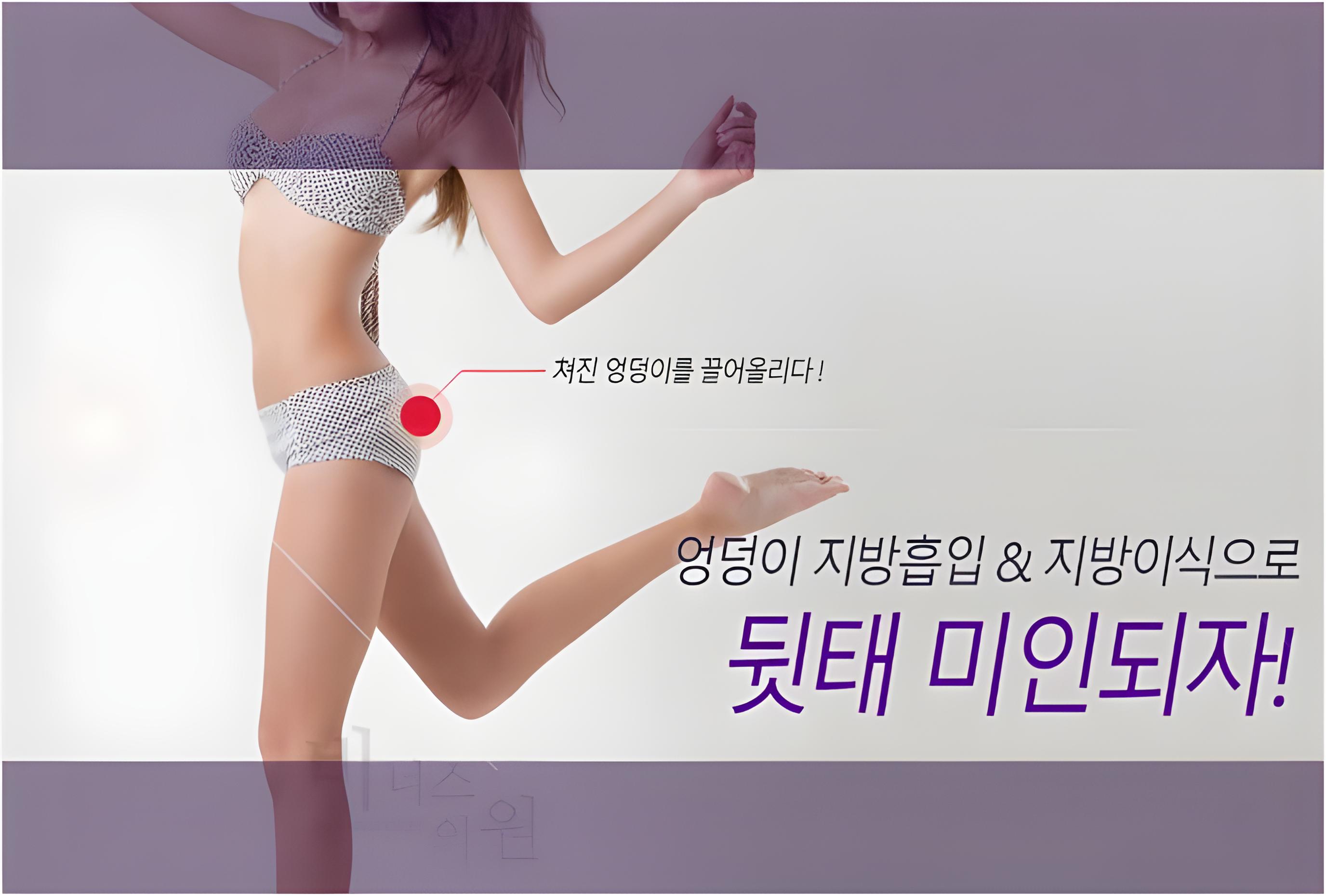 엉덩이 지방흡입 수술 이미지 — 엉덩이 부위 압박복 관리