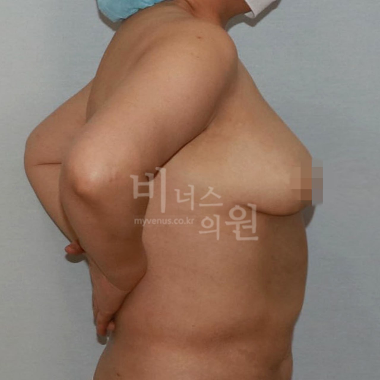 가슴축소 지방흡입 수술 후 — 측면 후