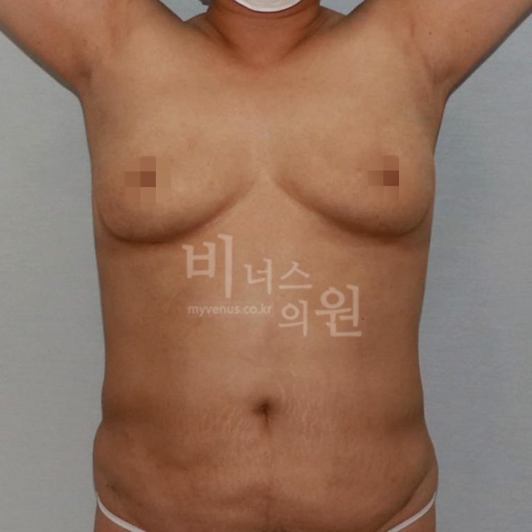 가슴 줄이고 달라진 것들 — 지방흡입 가슴축소 후기