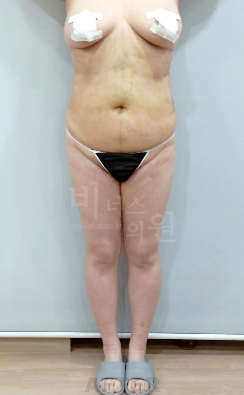 엉덩이 볼륨업 지방흡입 수술 후 정면 비너스의원
