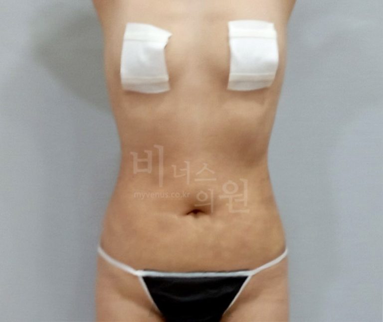 복부 지방흡입 후 회복 이야기 — 수술 당일부터 한 달까지 솔직하게